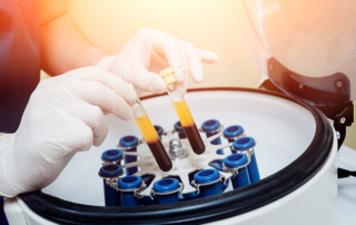TOSM-PRP-Therapy
