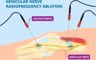 Genicular Nerve Block Radio Frequency Ablation For Knee Pain — TOSM Delray Beach