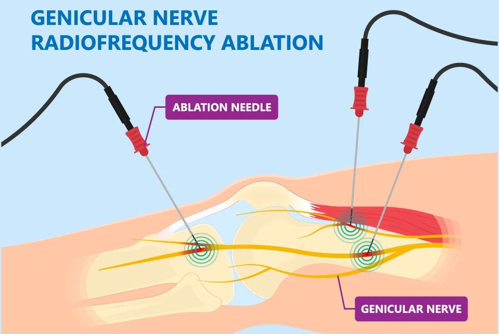 Genicular Nerve Block Radio Frequency Ablation For Knee Pain — TOSM Delray Beach