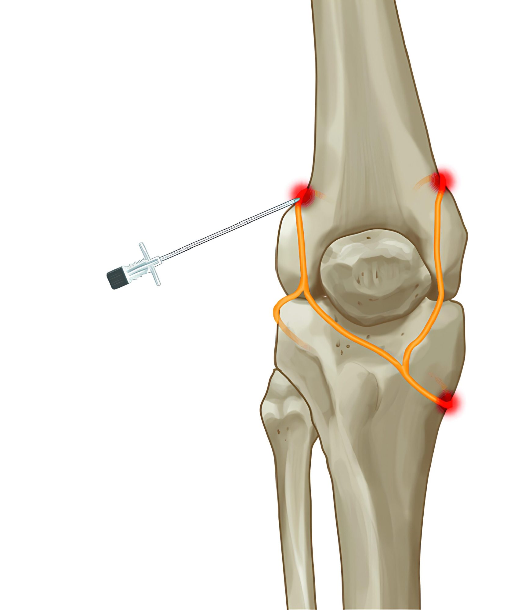 Genicular radiofrequency ablation for chronic knee pain at TOSM, Delray Beach, FL